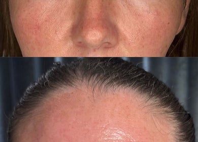 Before and after facial treatment at Bareface Skin Clinic, Liverpool, England, GB showing clear results.