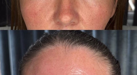 Before and after facial treatment at Bareface Skin Clinic, Liverpool, England, GB showing clear results.