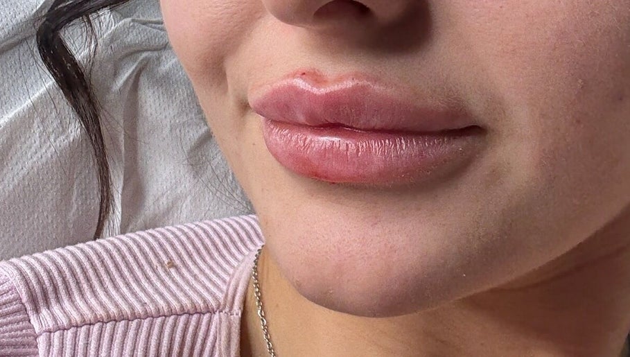 Closeup of enhanced lips at Aestheticsandskinbyjazmin, Ashington, England, GB.