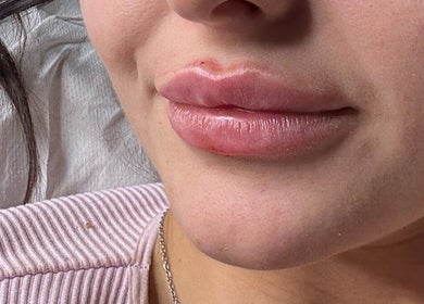 Closeup of enhanced lips at Aestheticsandskinbyjazmin, Ashington, England, GB.