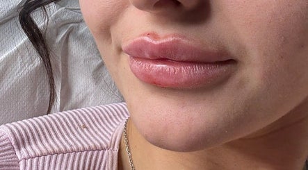 Closeup of enhanced lips at Aestheticsandskinbyjazmin, Ashington, England, GB.