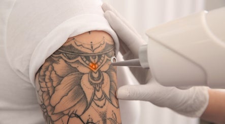 Détatouage au laser à New Life Skin, Gibloux, Fribourg, CH. Méthode avancée pour une peau renouvelée.