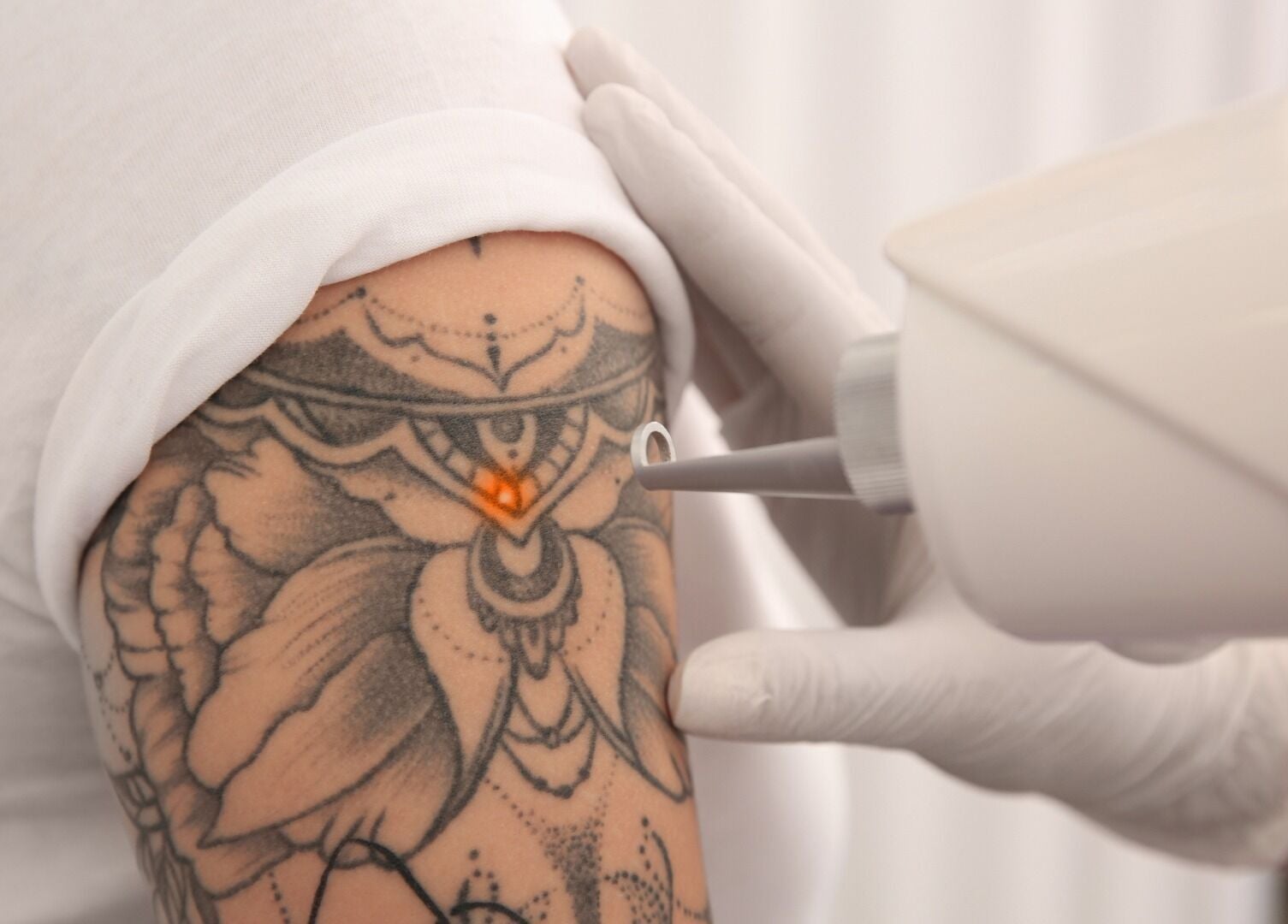 Suppression de tatouage par laser au New Life Skin, Gibloux, Fribourg, CH.