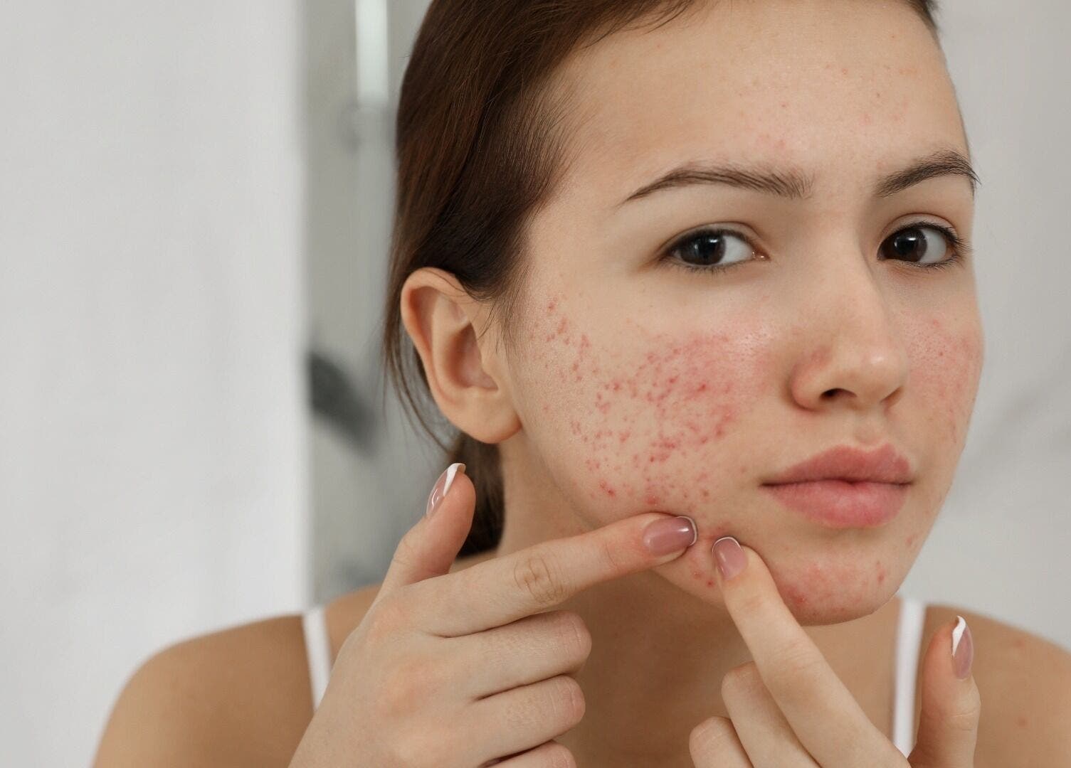 Femme traitant sa peau à New Life Skin, Gibloux, Fribourg, CH. Soins contre l'acné.