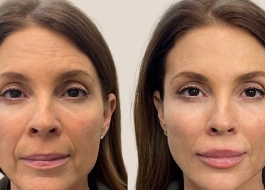 Before and after of skin treatment at Diamond M Aesthetics in Brighton and Hove, England, GB.