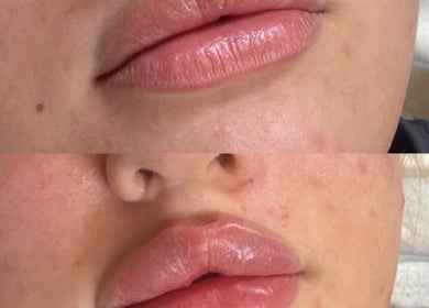 Before and after lip treatment at Daly Aesthetics, Little Hulton, England, GB.