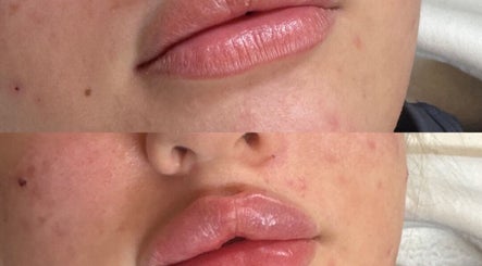 Before and after lip treatment at Daly Aesthetics, Little Hulton, England, GB.