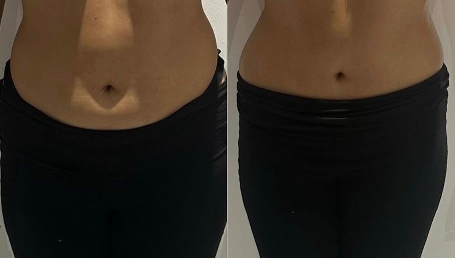 Before and after waist transformation at Detox and Drain, Radcliffe, England, GB showcasing slimming results.