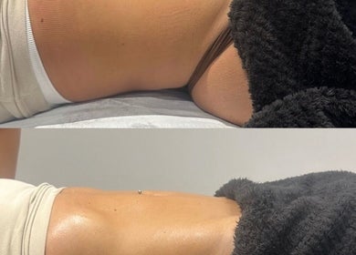 Before and after body contouring at Detox and Drain, Radcliffe, England, GB, showcasing visible skin improvement.