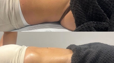 Before and after body contouring at Detox and Drain, Radcliffe, England, GB, showcasing visible skin improvement.