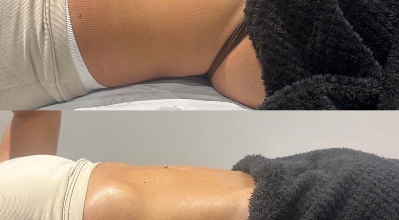 Before and after body contouring at Detox and Drain, Radcliffe, England, GB, showcasing visible skin improvement.