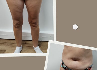 Avant et après soins minceur à Les femmes d'abord, Paris, Île-de-france, FR.