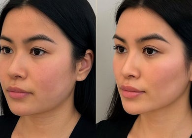 Before and after facial rejuvenation at SAREEN MEDICAL AND AESTHETICS, CASTLEKNOCK, County Dublin, IE.