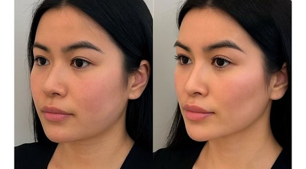 Before and after facial rejuvenation at SAREEN MEDICAL AND AESTHETICS, CASTLEKNOCK, County Dublin, IE.