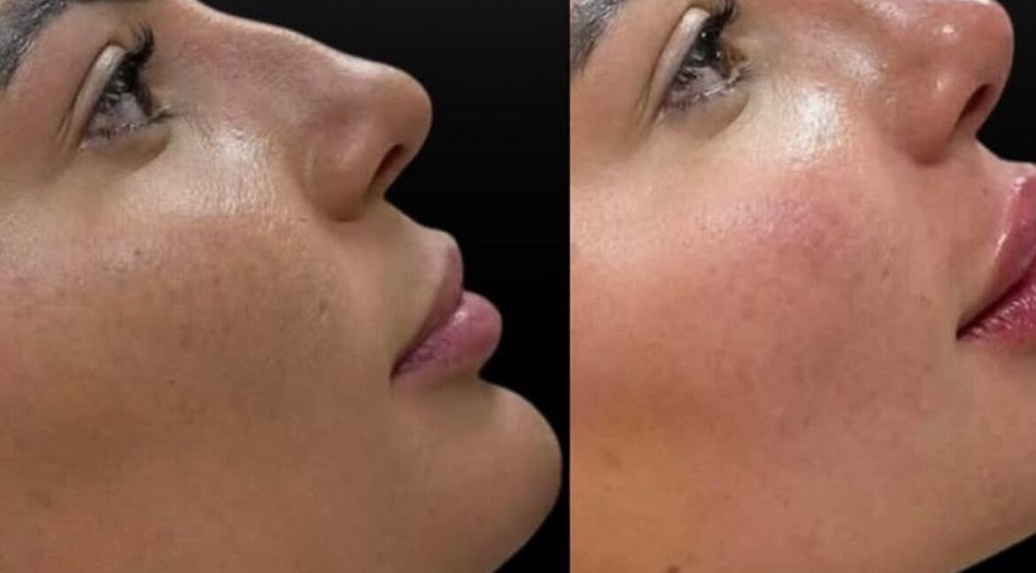 Before and after skin treatment at Marbella Med Spa, Jackson Heights, NY, US, showcasing refreshed skin.