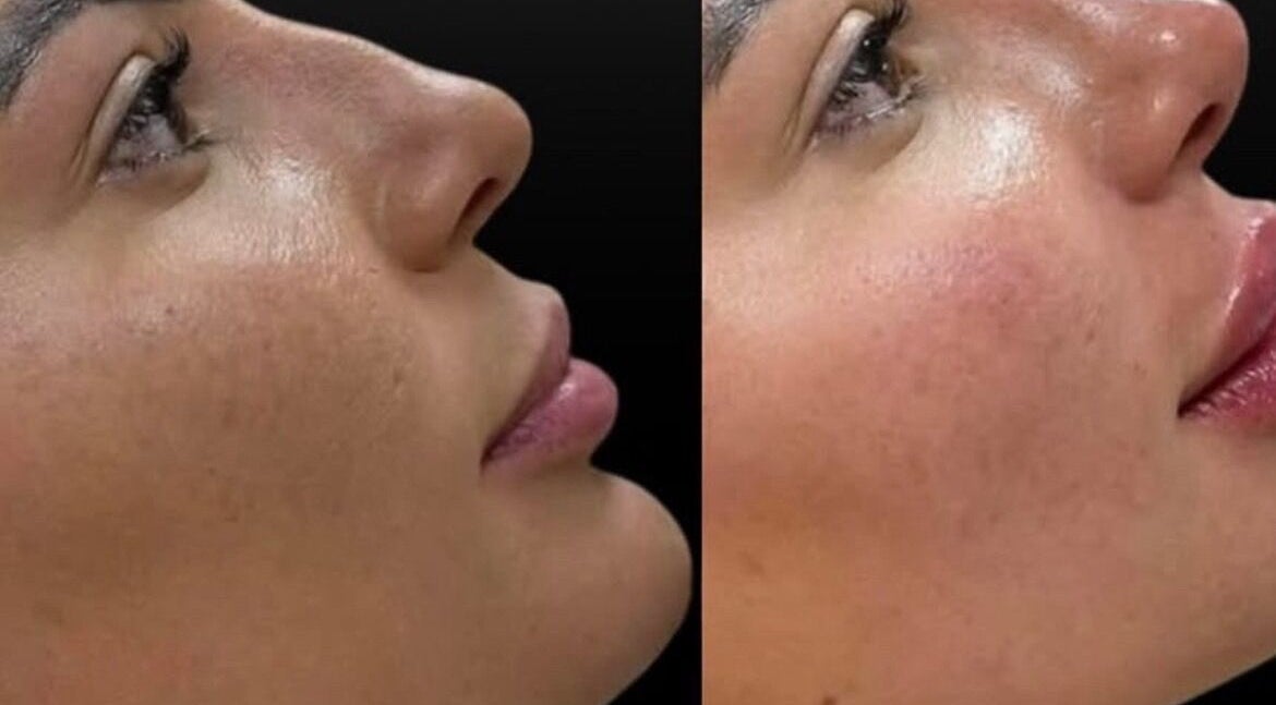 Before and after skin treatment at Marbella Med Spa, Jackson Heights, NY, US, showcasing refreshed skin.