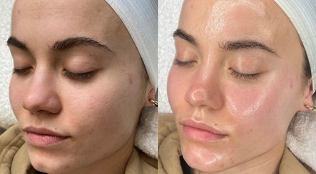 Facial transformation at Positive Skincare, Monton, England, GB: before and after glowing skin treatment.