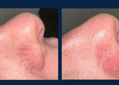 Nose skin before and after treatment at The Laser Studio EK, East Kilbride, College Milton South, Scotland, GB.