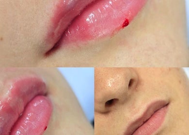 Close-up of lip enhancement treatment at Sweet Epil Beauty, London, England, GB.