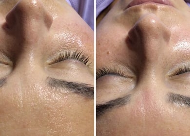 Close-up van gezicht voor en na gezichtsbehandeling bij Glow By Ems, Arkel, Zuid-holland, NL.