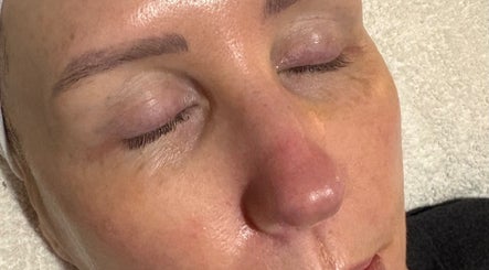 Close-up of rejuvenated skin after treatment at SKNCO, East Kilbride, Scotland, GB.