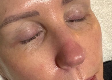 Close-up of a relaxed face post-treatment at SKNCO, East Kilbride, Scotland, GB, showcasing smooth skin.