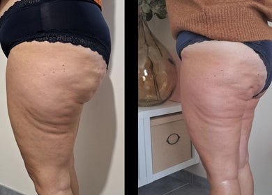 Résultats d'un traitement anti-cellulite chez In Dermo, Milhaud, Occitanie, FR.