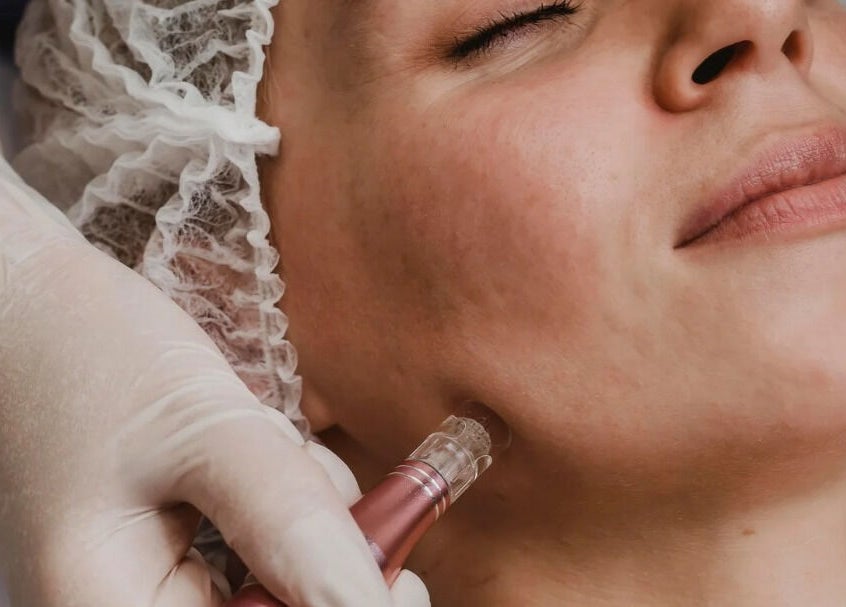 Facial treatment at Hina's Beauty Work Ltd, Auckland, Auckland, NZ, showcasing a microdermabrasion session.