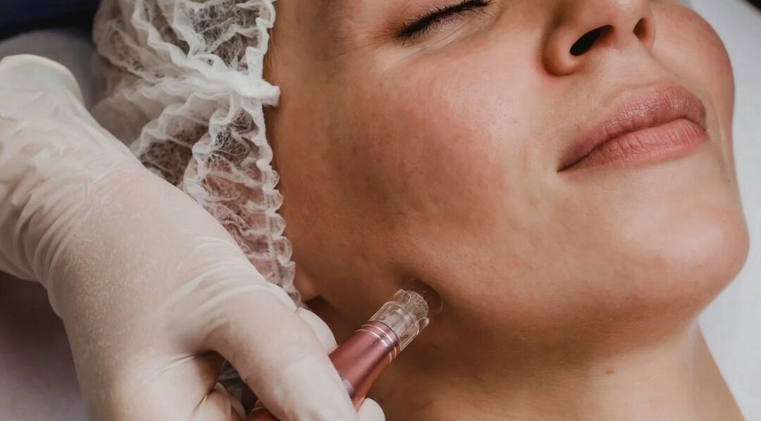 Facial treatment at Hina's Beauty Work Ltd, Auckland, Auckland, NZ, showcasing a microdermabrasion session.