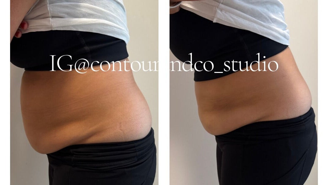 Before and after tummy contouring at Contour & Co. Studio, Maple Ridge, British Columbia, CA.