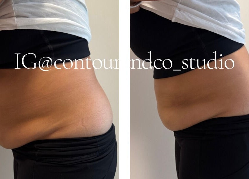 Before and after tummy contouring at Contour & Co. Studio, Maple Ridge, British Columbia, CA.