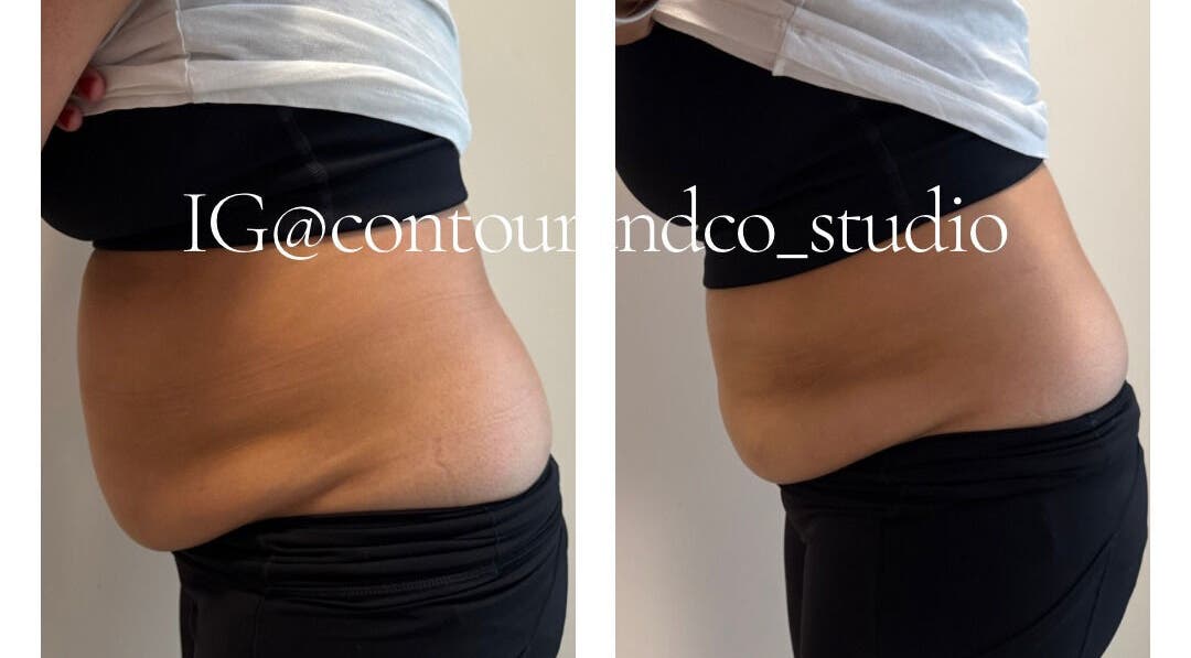 Before and after tummy contouring at Contour & Co. Studio, Maple Ridge, British Columbia, CA.