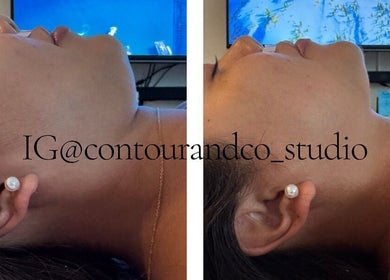 Before and after chin contouring at Contour & Co. Studio, Maple Ridge, British Columbia, CA.
