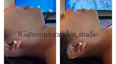 Before and after chin contouring at Contour & Co. Studio, Maple Ridge, British Columbia, CA.