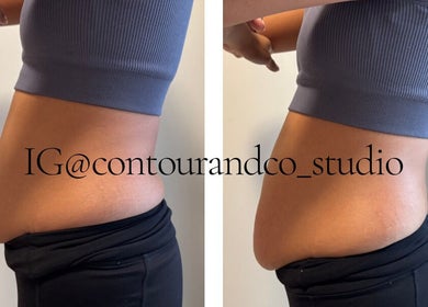 Before and after body contouring at Contour & Co. Studio, Maple Ridge, British Columbia, CA.