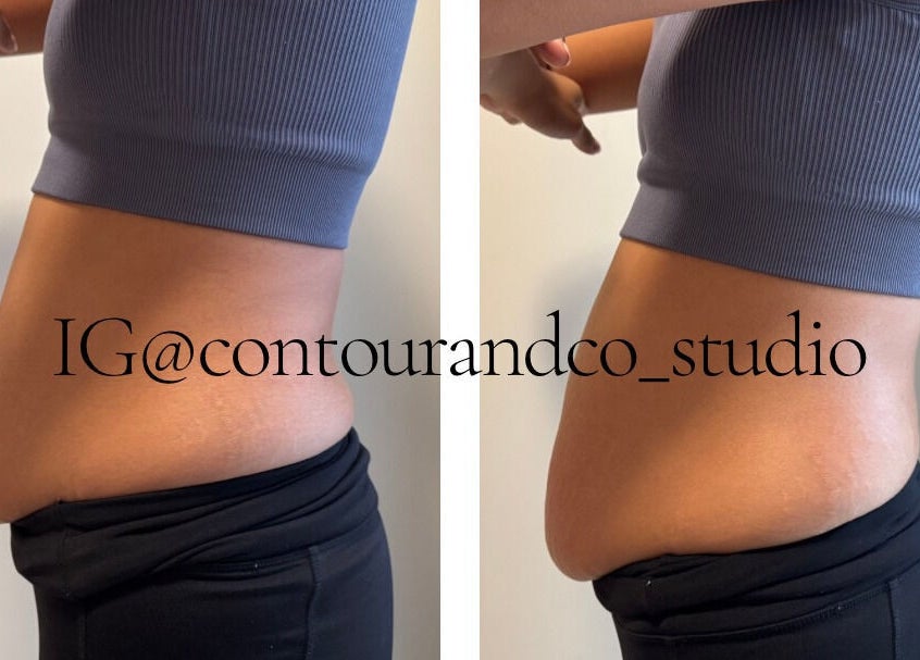 Before and after body contouring at Contour & Co. Studio, Maple Ridge, British Columbia, CA.