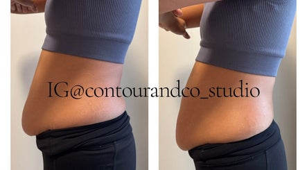 Before and after body contouring at Contour & Co. Studio, Maple Ridge, British Columbia, CA.