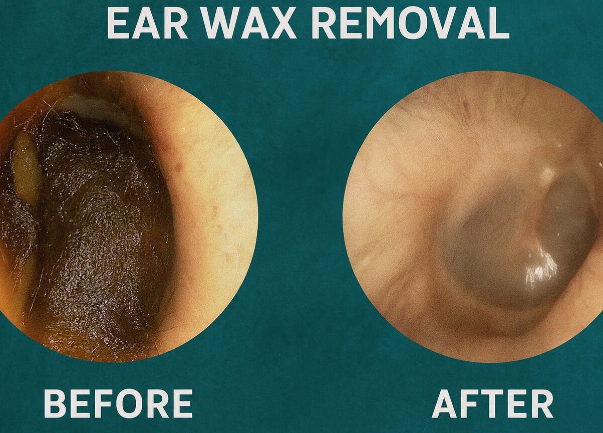 Before and after ear wax removal at Audiwell Ear Health, Kirkby In Ashfield, England, GB.