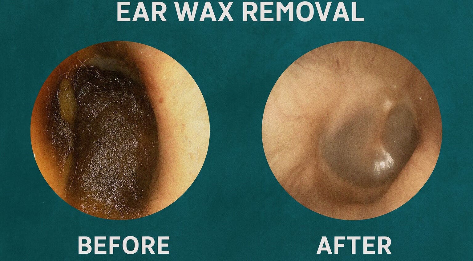 Before and after ear wax removal at Audiwell Ear Health, Kirkby In Ashfield, England, GB.