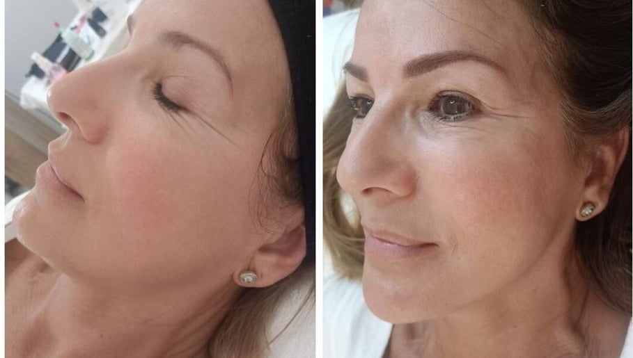 Tratamiento facial en VBtupielensumejorversion, Huelva, Andalucía, ES mostrando resultados antes y después.