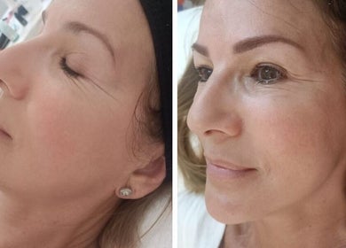 Tratamiento facial en VBtupielensumejorversion, Huelva, Andalucía, ES mostrando resultados antes y después.