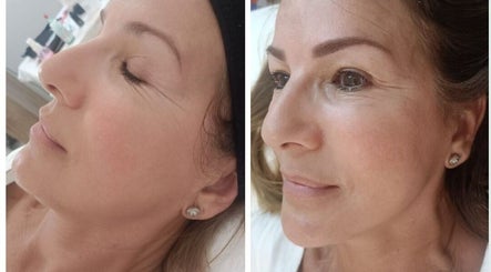 Tratamiento facial en VBtupielensumejorversion, Huelva, Andalucía, ES mostrando resultados antes y después.