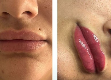Transformación labial en VBtupielensumejorversion en Huelva, Andalucía, ES. Antes y después del tratamiento.