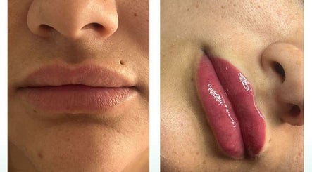 Transformación labial en VBtupielensumejorversion en Huelva, Andalucía, ES. Antes y después del tratamiento.