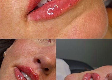 Close-up of glossy lips after treatment at Aura Aesthetics, Leeds, England, GB.