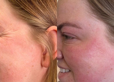 Before and after skin treatment at Aura Aesthetics, Leeds, England, GB, showing reduced wrinkles and smoother skin.