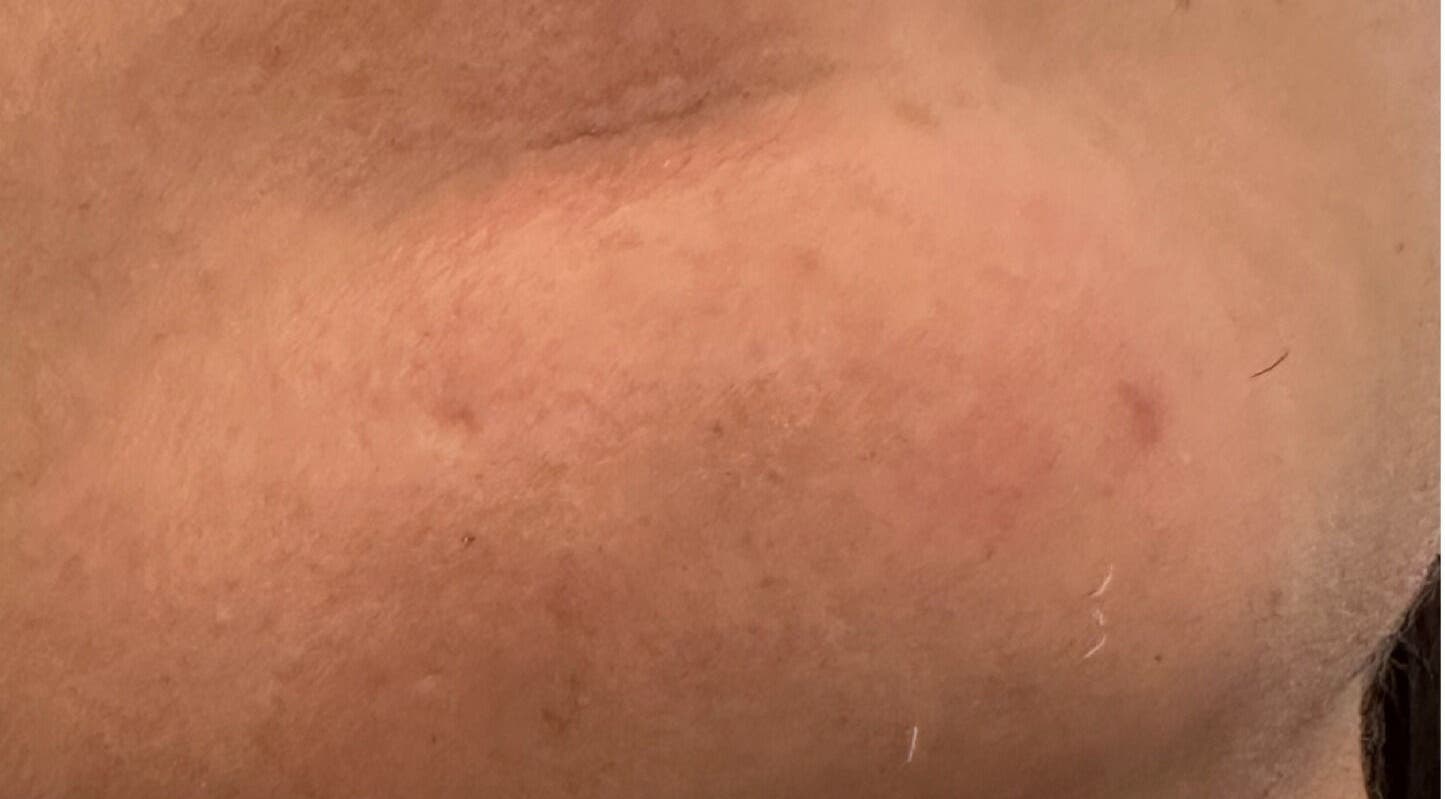 Tratamiento facial en Le’ Piel Clinic & Spa, Bayamón, Bayamón, PR, destacando piel saludable.