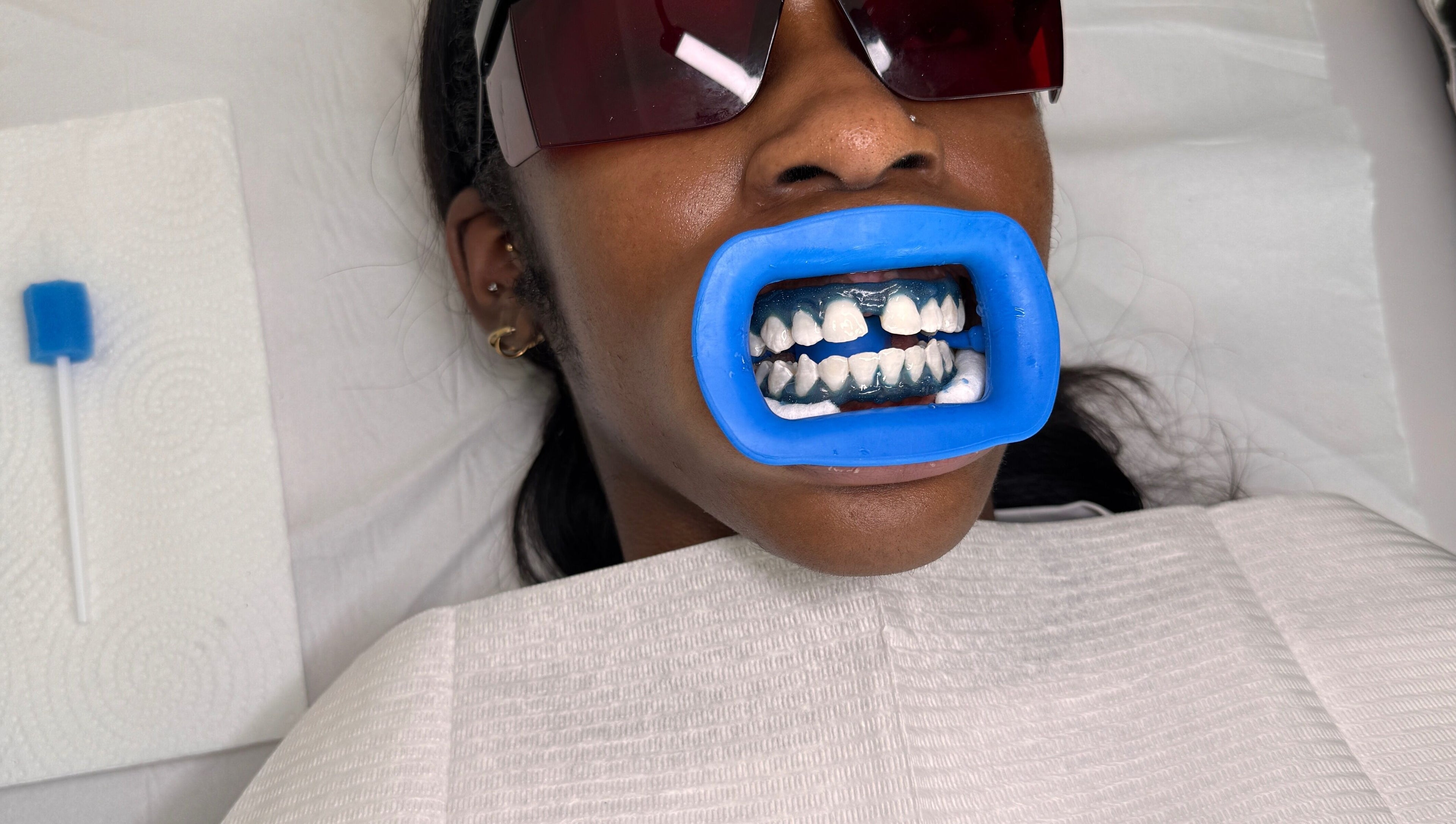 Teeth whitening procedure at Whitesbylia in London, England, GB with blue mouthguard and protective eyewear.