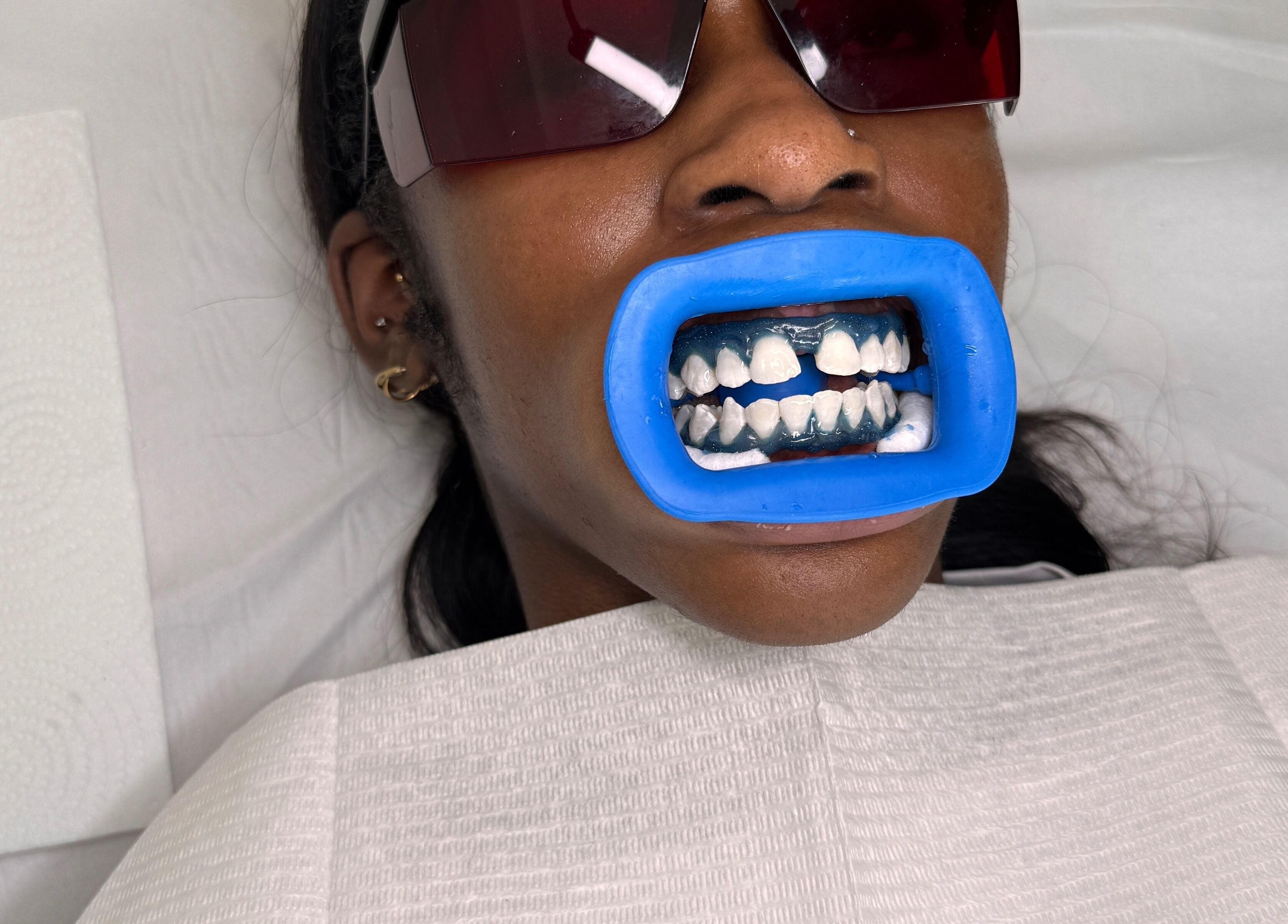 Teeth whitening procedure at Whitesbylia in London, England, GB with blue mouthguard and protective eyewear.