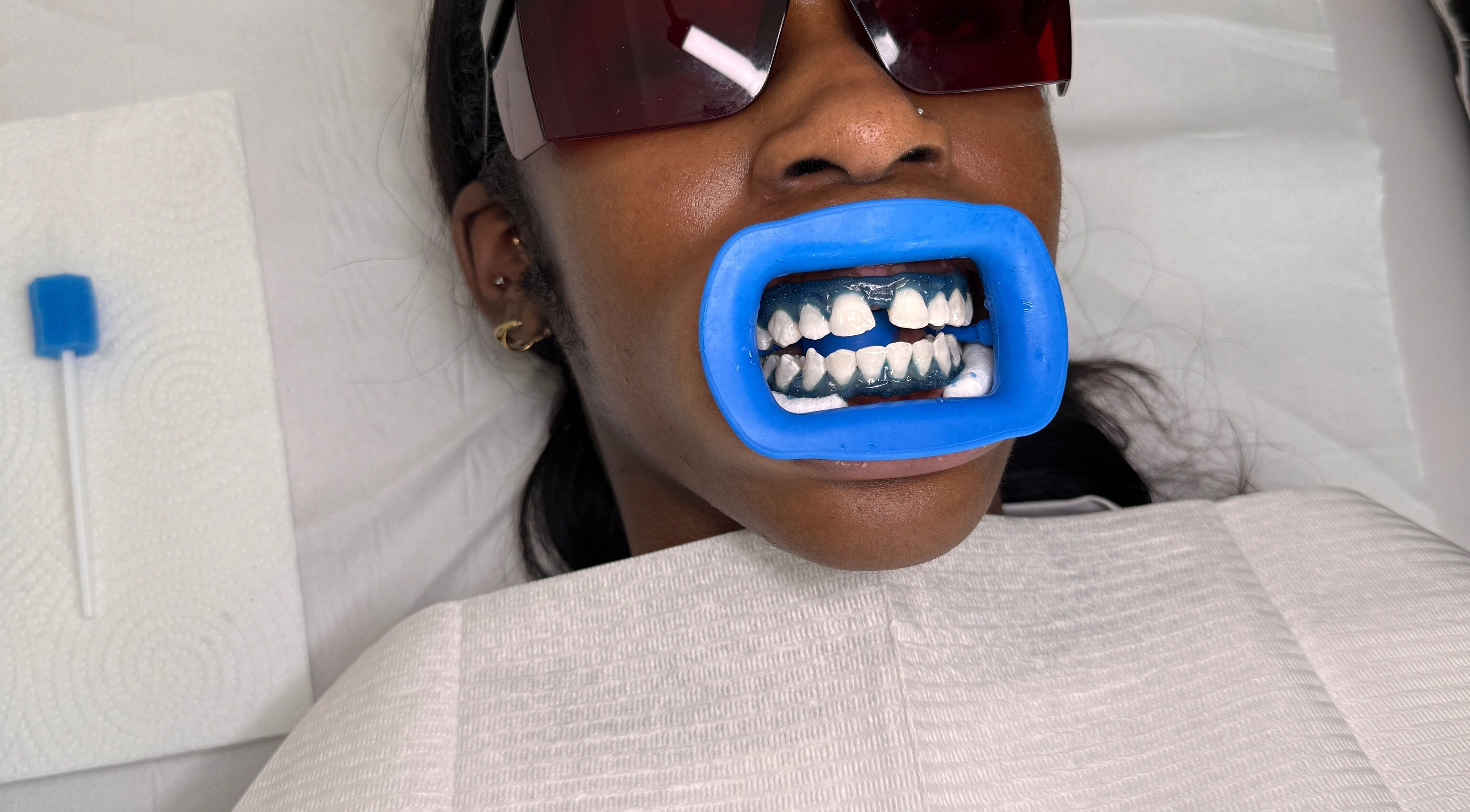 Teeth whitening procedure at Whitesbylia in London, England, GB with blue mouthguard and protective eyewear.